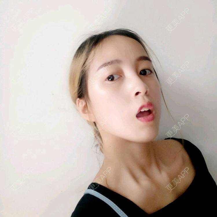 更美 - 咕叽咕叽77的埋线提升经验 | 埋线提升 | 武汉