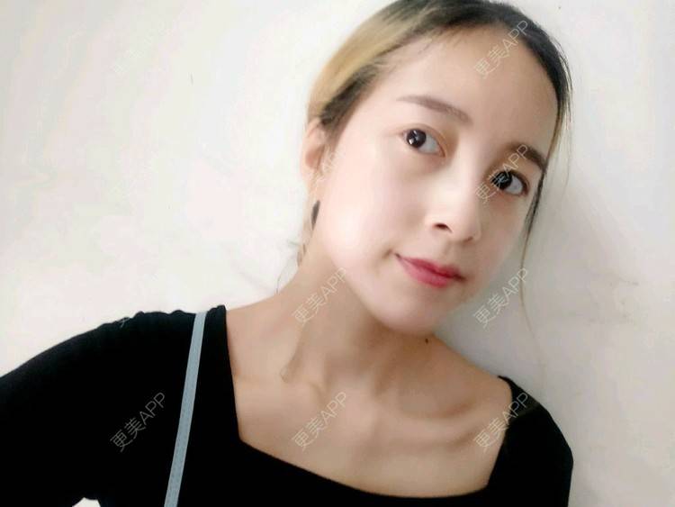 更美 - 咕叽咕叽77的埋线提升经验 | 埋线提升 | 武汉
