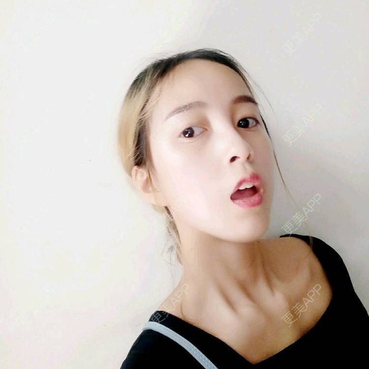 更美 - 咕叽咕叽77的埋线提升经验 | 埋线提升 | 武汉
