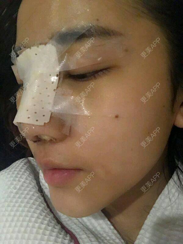 更美 - 更美用户6Ldsb8odGC的鼻部综合经验 | 隆鼻失败修复 | 鼻部综合 | 鼻部多项 | 鼻修复 | 南宁