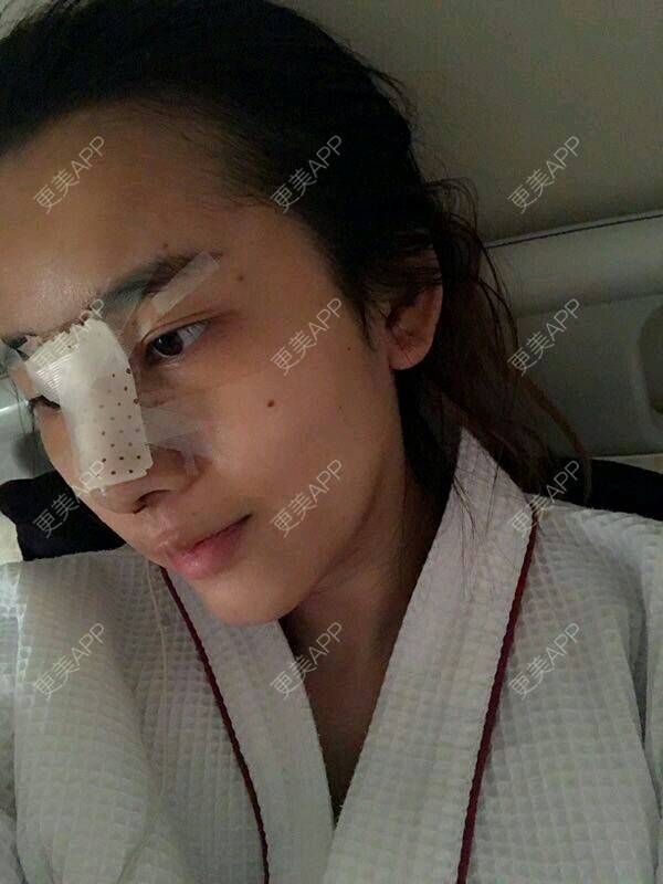 更美 - 更美用户6Ldsb8odGC的鼻部综合经验 | 隆鼻失败修复 | 鼻部综合 | 鼻部多项 | 鼻修复 | 南宁