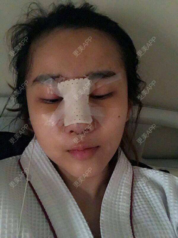 更美 - 更美用户6Ldsb8odGC的鼻部综合经验 | 隆鼻失败修复 | 鼻部综合 | 鼻部多项 | 鼻修复 | 南宁