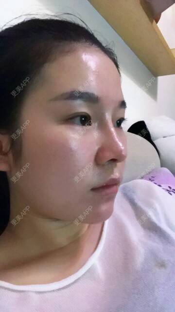 更美 - 一个勺子的逆袭的鼻部整形经验 | 鼻部整形 | 假体隆鼻 | 综合隆鼻 | 长沙