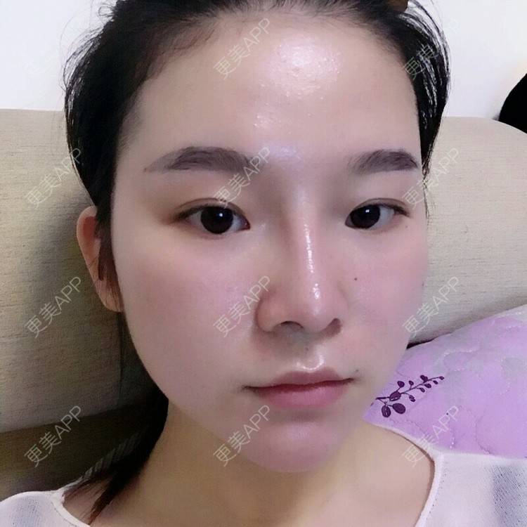 更美 - 一个勺子的逆袭的鼻部整形经验 | 鼻部整形 | 假体隆鼻 | 综合隆鼻 | 长沙