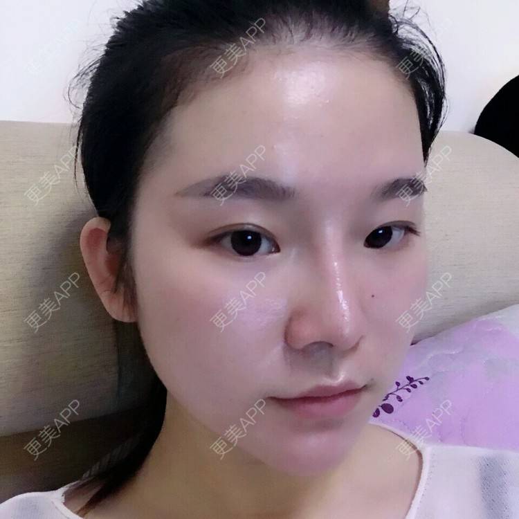 更美 - 一个勺子的逆袭的鼻部整形经验 | 鼻部整形 | 假体隆鼻 | 综合隆鼻 | 长沙