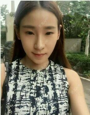 更美 - 更美用户lSGbEujLkH的水光项目经验 | 玻尿酸导入 | 水光项目 | 杭州
