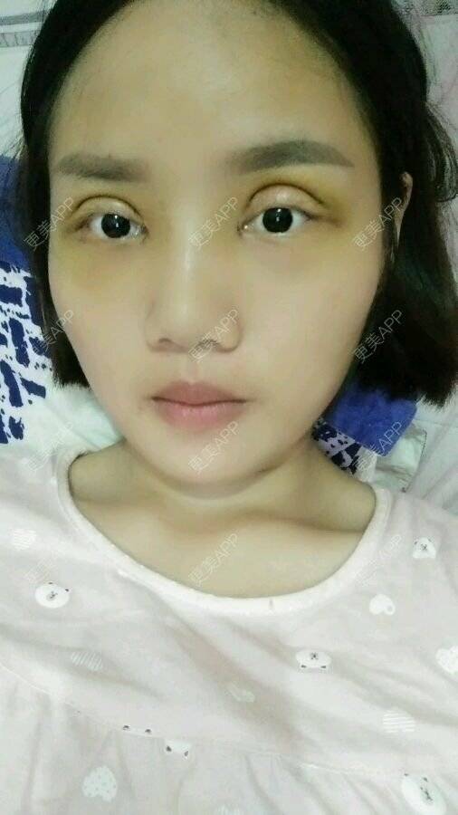 更美 - 口口做好的双眼皮经验 | 北京 | 精雕全切双眼皮 | 双眼皮 | 眼部整形