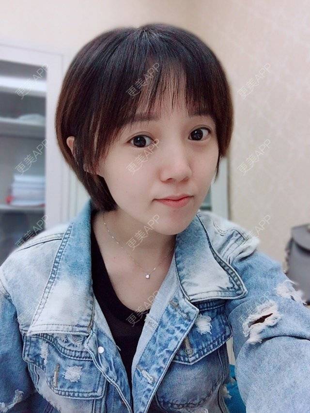 更美 - 平小瓶er的双眼皮经验 | 视频日记 | 美丽日记 | 同仁医院马涛 | 公立医生 | 全切双眼皮专家 | 双眼皮 | 精雕全切双眼皮 | 精华自荐 | 名流双眼皮 | 专家 | 微创三点双眼皮开眼角 | 北京
