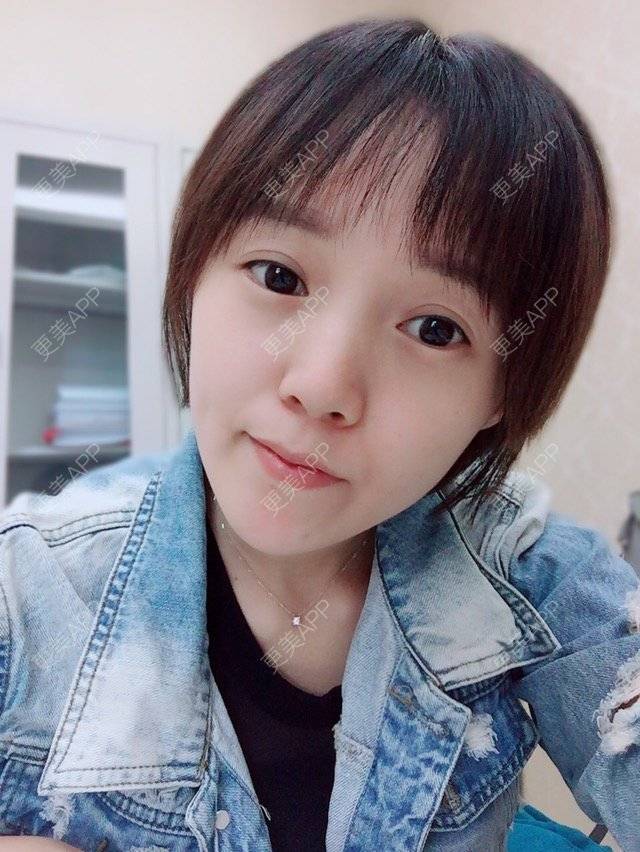 更美 - 平小瓶er的双眼皮经验 | 视频日记 | 美丽日记 | 同仁医院马涛 | 公立医生 | 全切双眼皮专家 | 双眼皮 | 精雕全切双眼皮 | 精华自荐 | 名流双眼皮 | 专家 | 微创三点双眼皮开眼角 | 北京