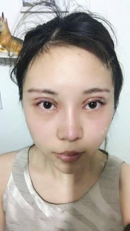 全切雙眼皮效果圖_杭膳淺唱幸福全切雙眼皮效果圖_術後69天__更美