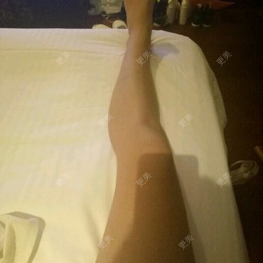 溶脂瘦腿