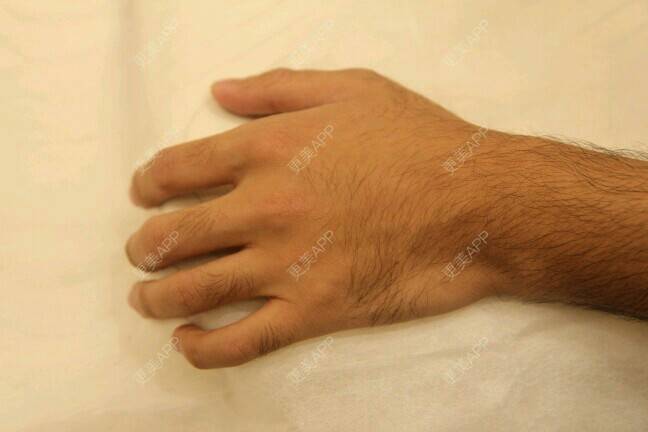 多毛的啊凡达的手臂脱毛日记