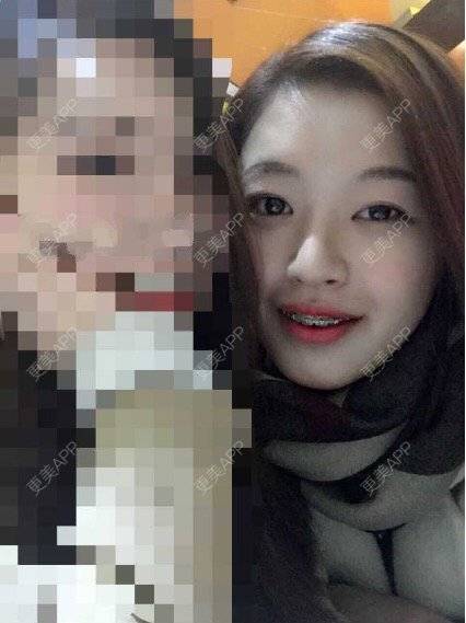 更美 - 隐形天使345的经验 | 牙齿口腔 | 牙齿正畸 | 西安