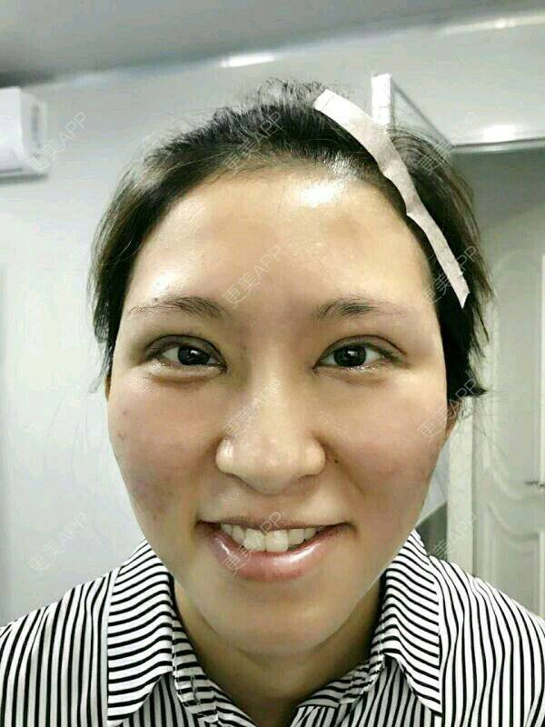 更美 - 喂！等等的全切双眼皮经验 | 内开眼角 | 上眼皮吸脂 | 全切双眼皮 | 天津