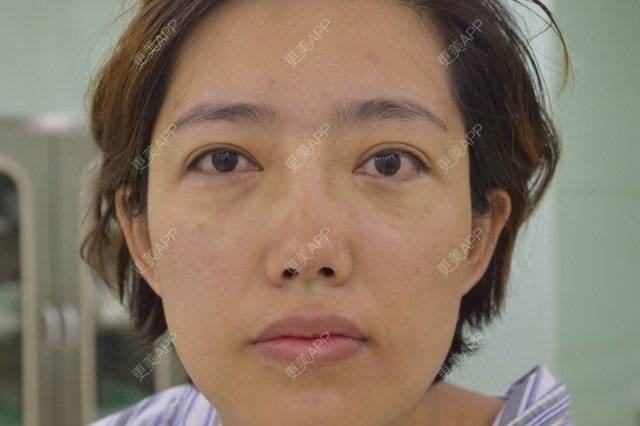 更美 - 北京美诗沁医疗美容的祛眼袋经验 | 北京 | 祛眼袋