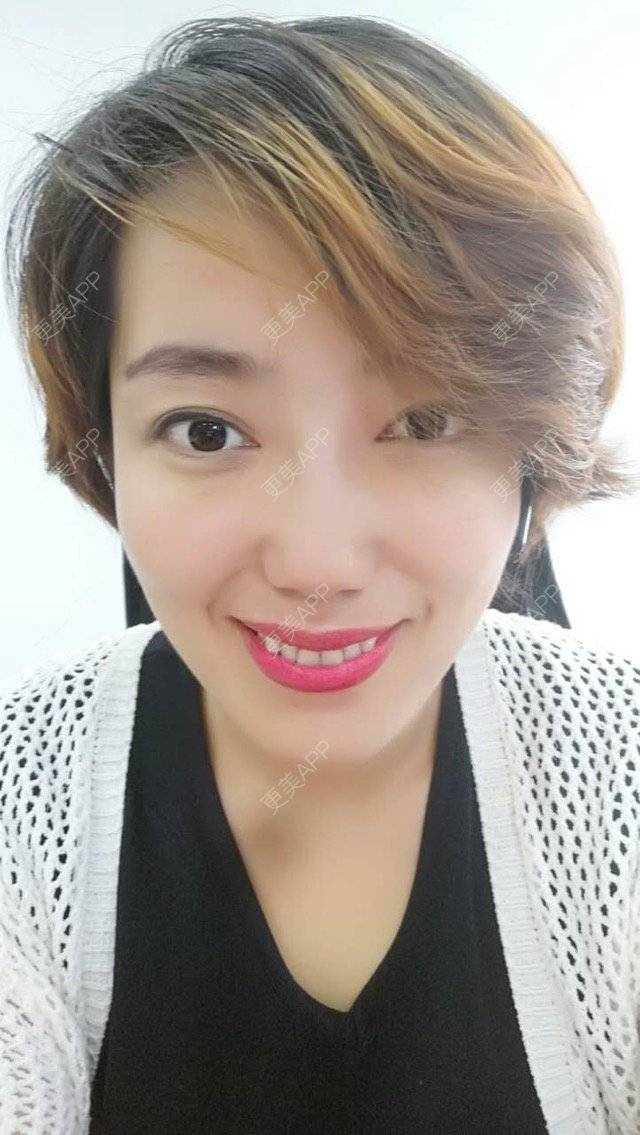 更美 - 北京美诗沁医疗美容的祛眼袋经验 | 北京 | 祛眼袋