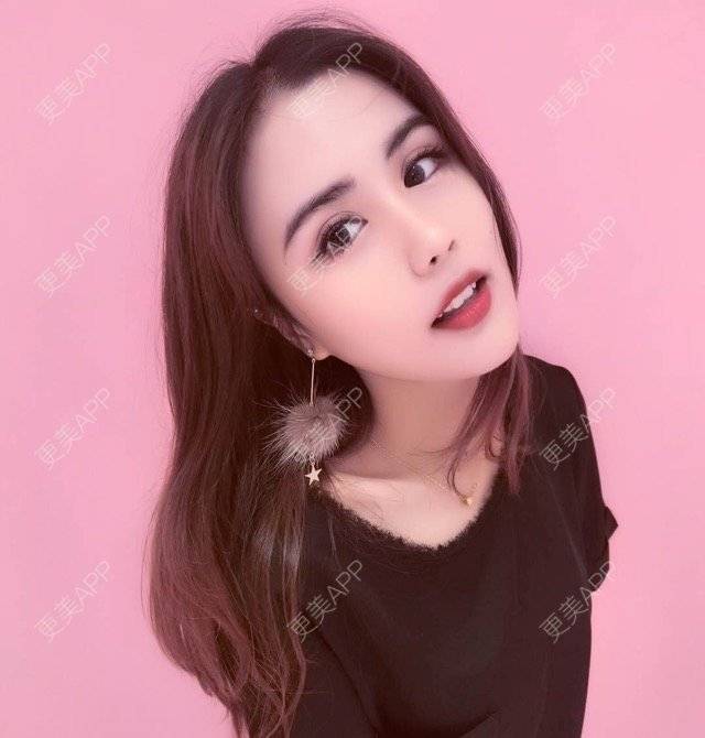 更美 - 敏girl的双眼皮日记 | 注射美容 | 眼部整形 | 双眼皮 | 重庆