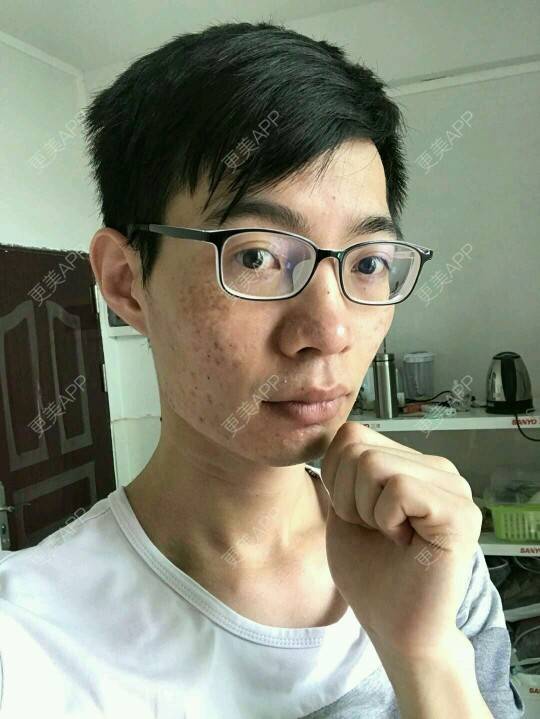 更美 - 更美用户PdQrraCkOQ的红蓝光清痘经验 | 红蓝光清痘 | 消炎祛痘 | 祛痘疤 | 广州