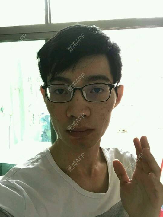 更美 - 更美用户PdQrraCkOQ的红蓝光清痘经验 | 红蓝光清痘 | 消炎祛痘 | 祛痘疤 | 广州