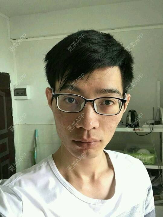 更美 - 更美用户PdQrraCkOQ的红蓝光清痘经验 | 红蓝光清痘 | 消炎祛痘 | 祛痘疤 | 广州