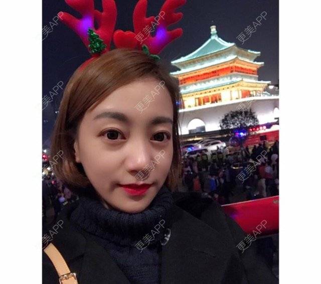 更美 - 大花卷毛的埋线双眼皮经验 | 武汉 | 埋线双眼皮 | 精切双眼皮