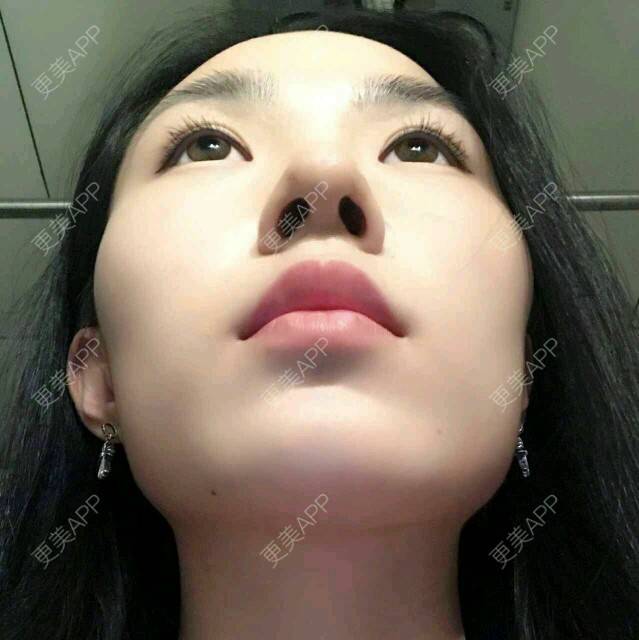 更美 - 大眼小黄人的鼻部膨体假体取出经验 | 上海 | 鼻部膨体假体取出