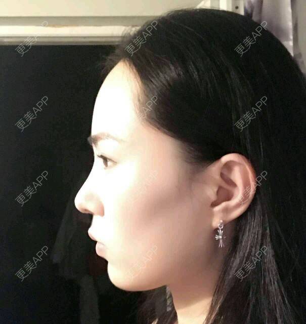 更美 - 大眼小黄人的鼻部膨体假体取出经验 | 上海 | 鼻部膨体假体取出