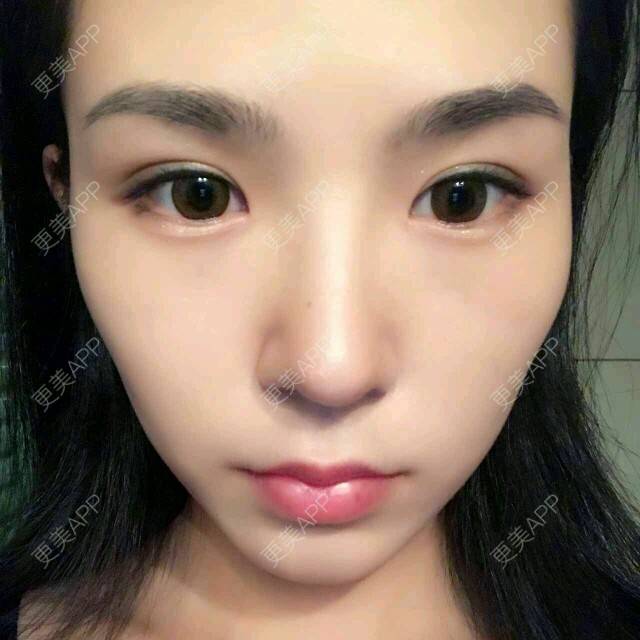 更美 - 大眼小黄人的鼻部膨体假体取出经验 | 上海 | 鼻部膨体假体取出