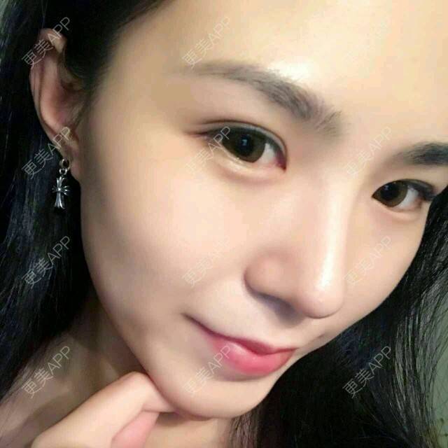 更美 - 大眼小黄人的鼻部膨体假体取出经验 | 上海 | 鼻部膨体假体取出