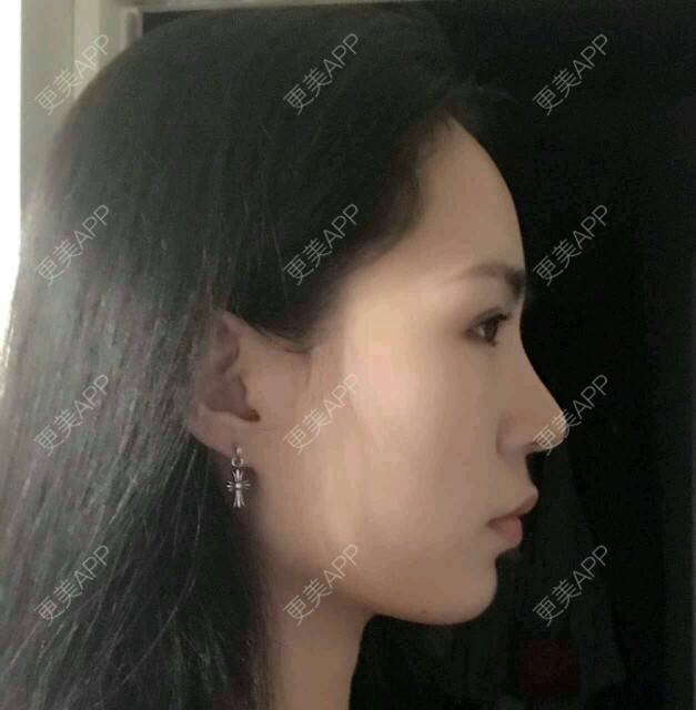 更美 - 大眼小黄人的鼻部膨体假体取出经验 | 上海 | 鼻部膨体假体取出