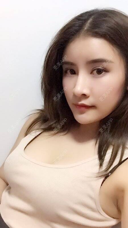 女神经的自体脂肪隆胸日记