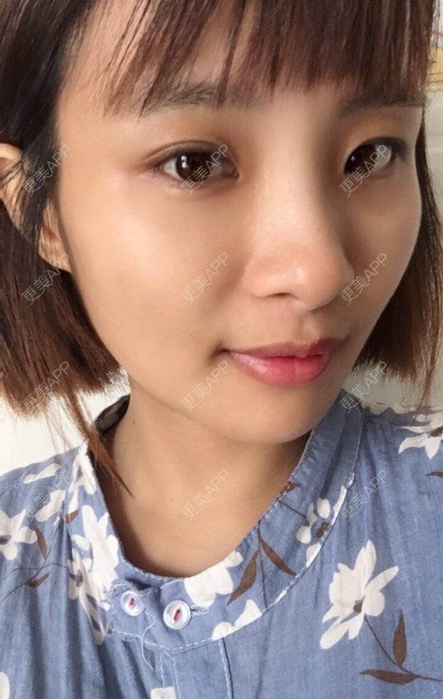 更美 - 照相机、的经验 | 注射美容 | 视频日记 | 重庆 | 自体脂肪丰全面部 | 吸脂手术