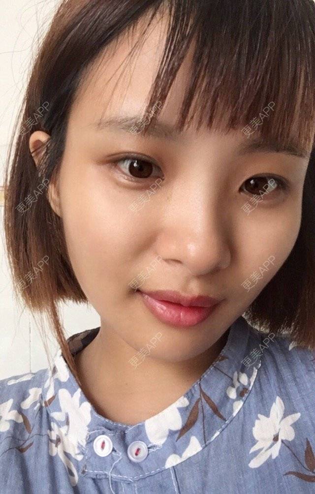 更美 - 照相机、的经验 | 注射美容 | 视频日记 | 重庆 | 自体脂肪丰全面部 | 吸脂手术