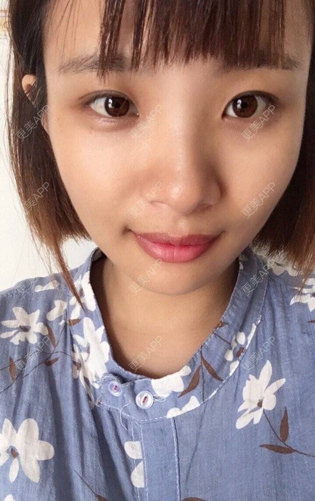 更美 - 照相机、的经验 | 注射美容 | 视频日记 | 重庆 | 自体脂肪丰全面部 | 吸脂手术
