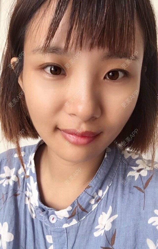 更美 - 照相机、的经验 | 注射美容 | 视频日记 | 重庆 | 自体脂肪丰全面部 | 吸脂手术