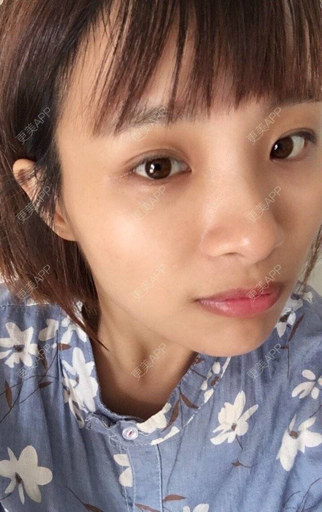 更美 - 照相机、的经验 | 注射美容 | 视频日记 | 重庆 | 自体脂肪丰全面部 | 吸脂手术