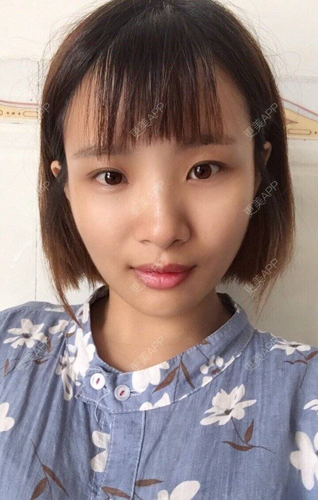 更美 - 照相机、的经验 | 注射美容 | 视频日记 | 重庆 | 自体脂肪丰全面部 | 吸脂手术