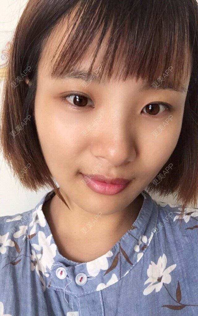更美 - 照相机、的经验 | 注射美容 | 视频日记 | 重庆 | 自体脂肪丰全面部 | 吸脂手术