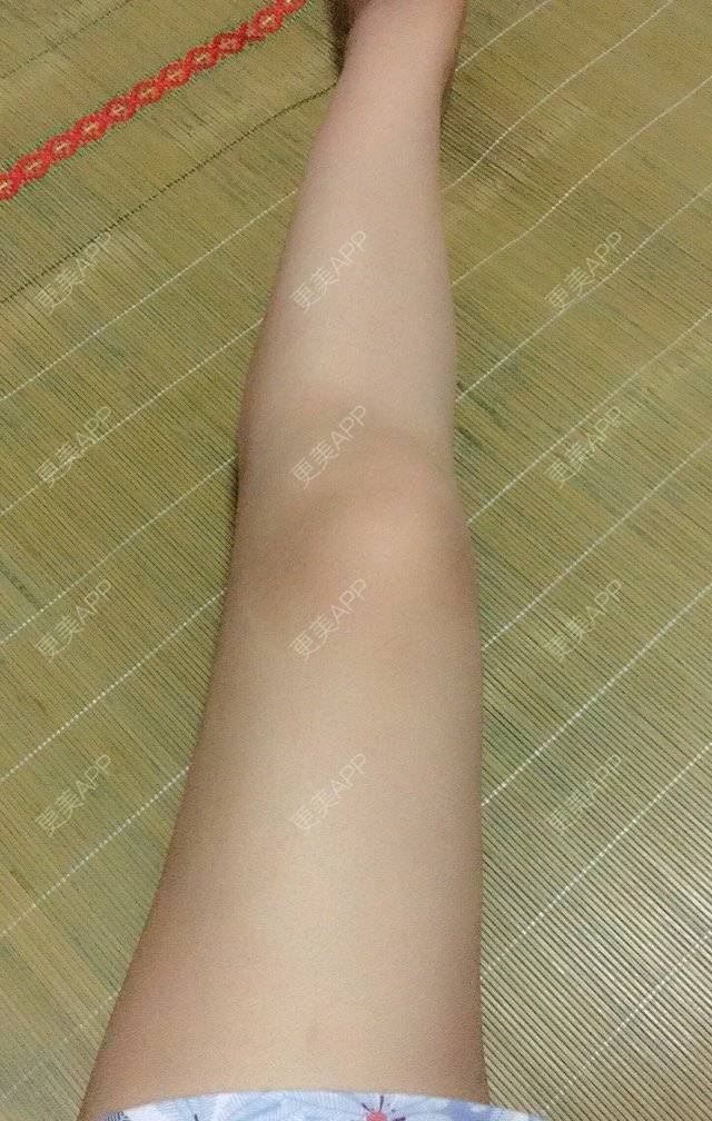 更美 - 照相机、的经验 | 注射美容 | 视频日记 | 重庆 | 自体脂肪丰全面部 | 吸脂手术