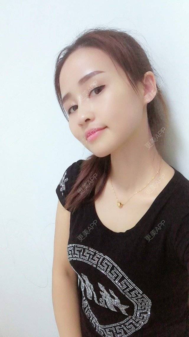 更美 - 狐狸-FOX的经验 | 重庆 | 自体脂肪填充面颊 | 自体脂肪填充额头