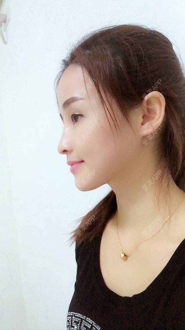 更美 - 狐狸-FOX的经验 | 重庆 | 自体脂肪填充面颊 | 自体脂肪填充额头