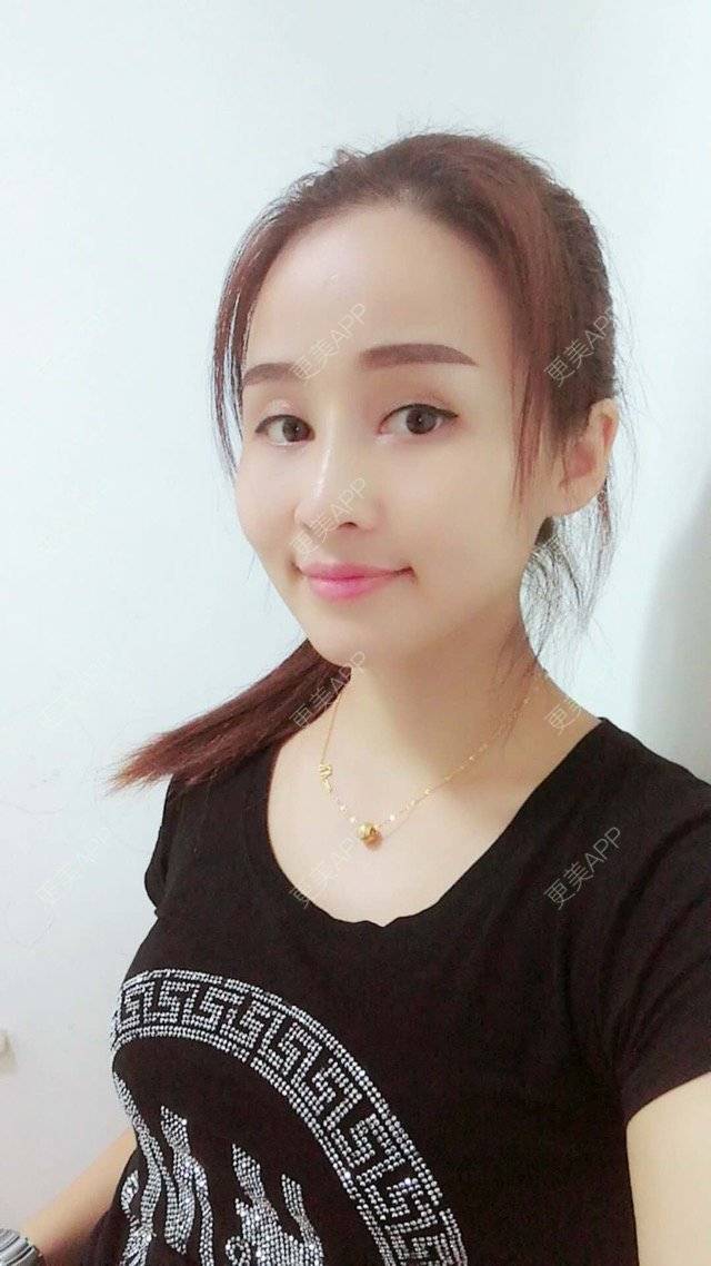 更美 - 狐狸-FOX的经验 | 重庆 | 自体脂肪填充面颊 | 自体脂肪填充额头