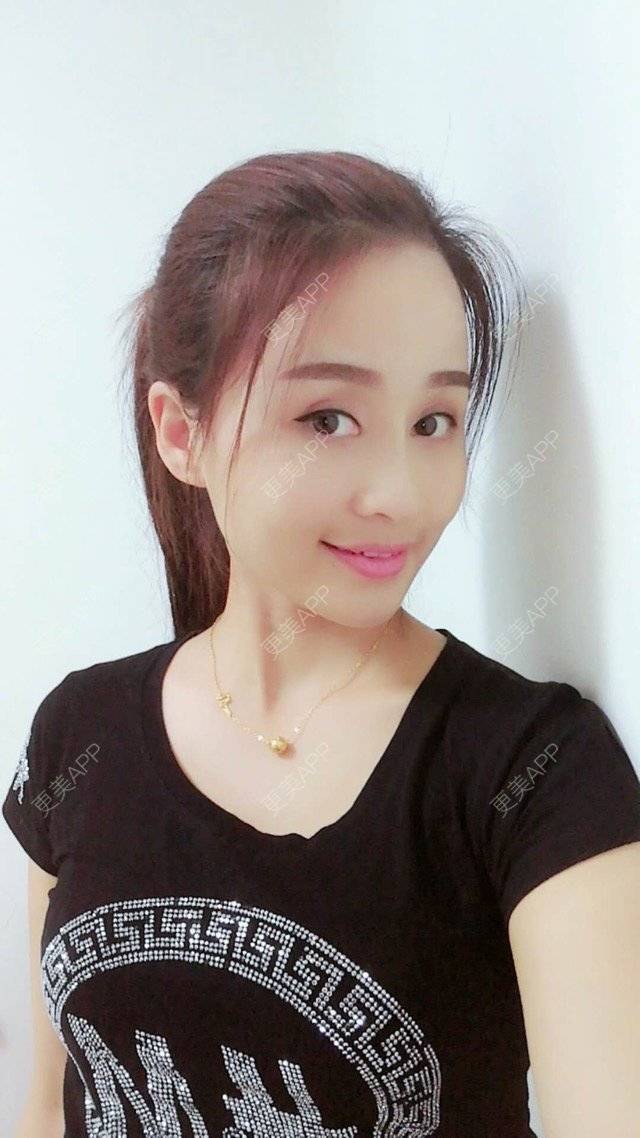 更美 - 狐狸-FOX的经验 | 重庆 | 自体脂肪填充面颊 | 自体脂肪填充额头