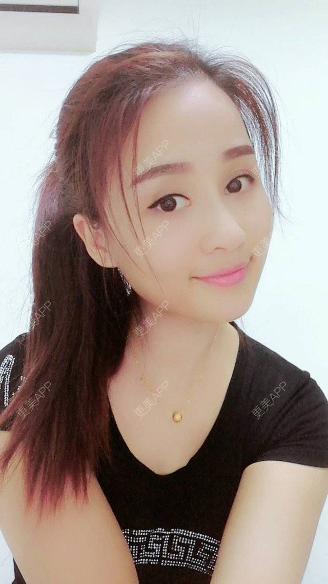 更美 - 狐狸-FOX的经验 | 重庆 | 自体脂肪填充面颊 | 自体脂肪填充额头