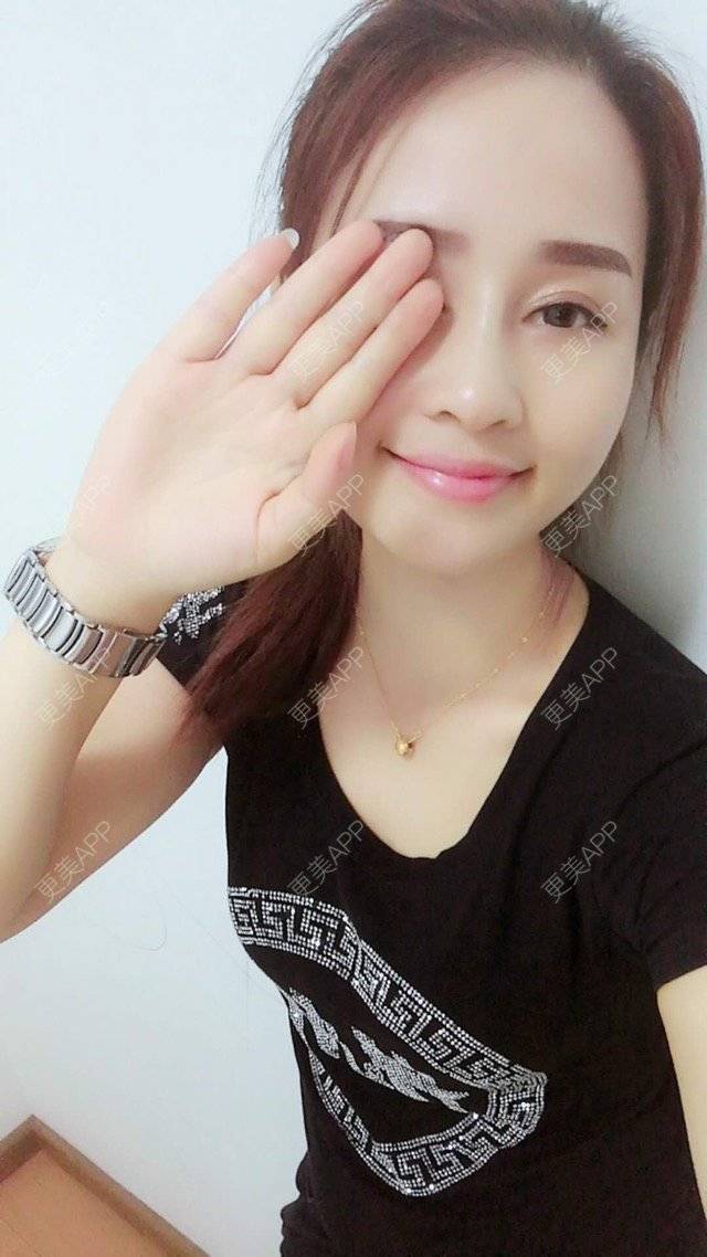 更美 - 狐狸-FOX的经验 | 重庆 | 自体脂肪填充面颊 | 自体脂肪填充额头