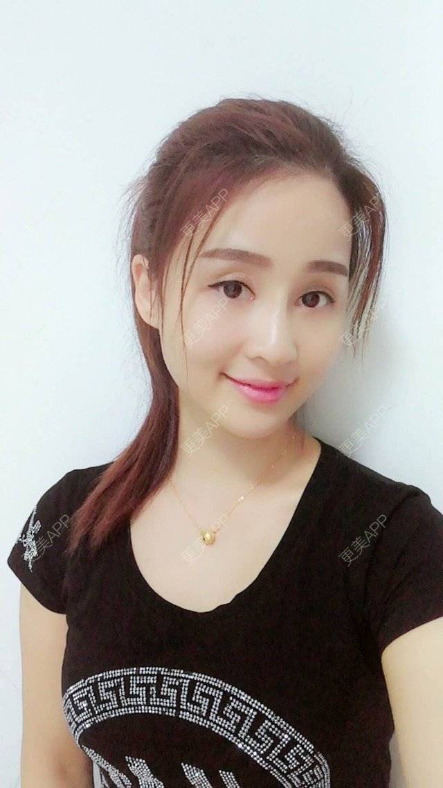 更美 - 狐狸-FOX的经验 | 重庆 | 自体脂肪填充面颊 | 自体脂肪填充额头
