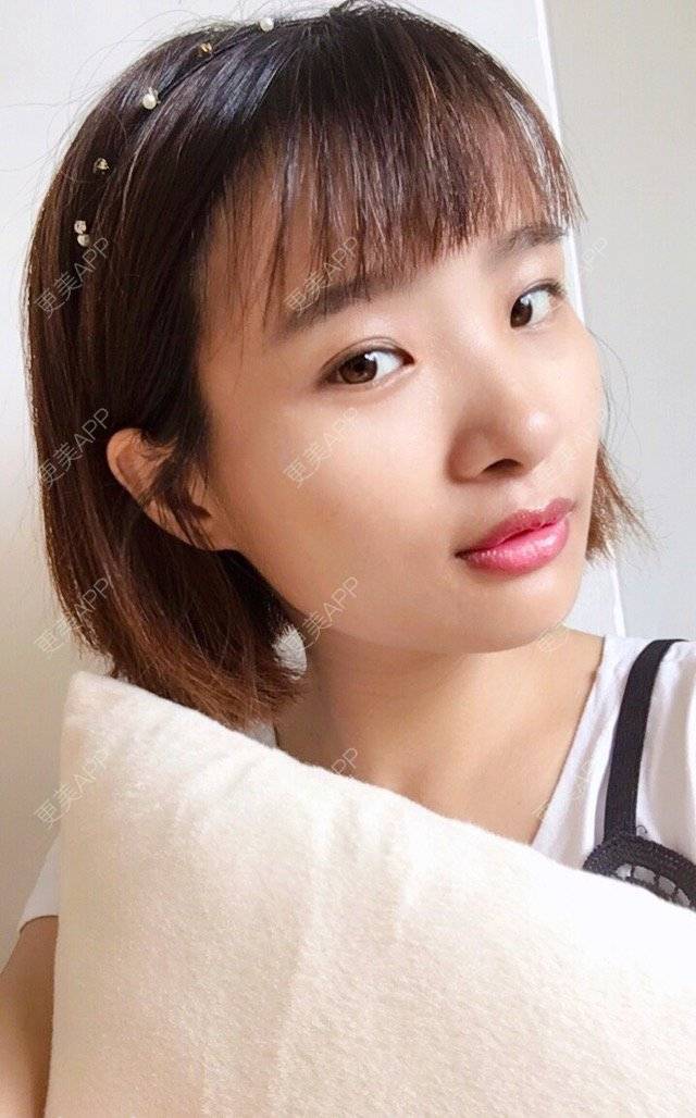 更美 - 照相机、的经验 | 注射美容 | 视频日记 | 重庆 | 自体脂肪丰全面部 | 吸脂手术