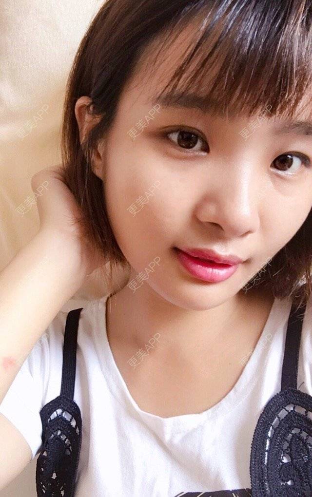 更美 - 照相机、的经验 | 注射美容 | 视频日记 | 重庆 | 自体脂肪丰全面部 | 吸脂手术