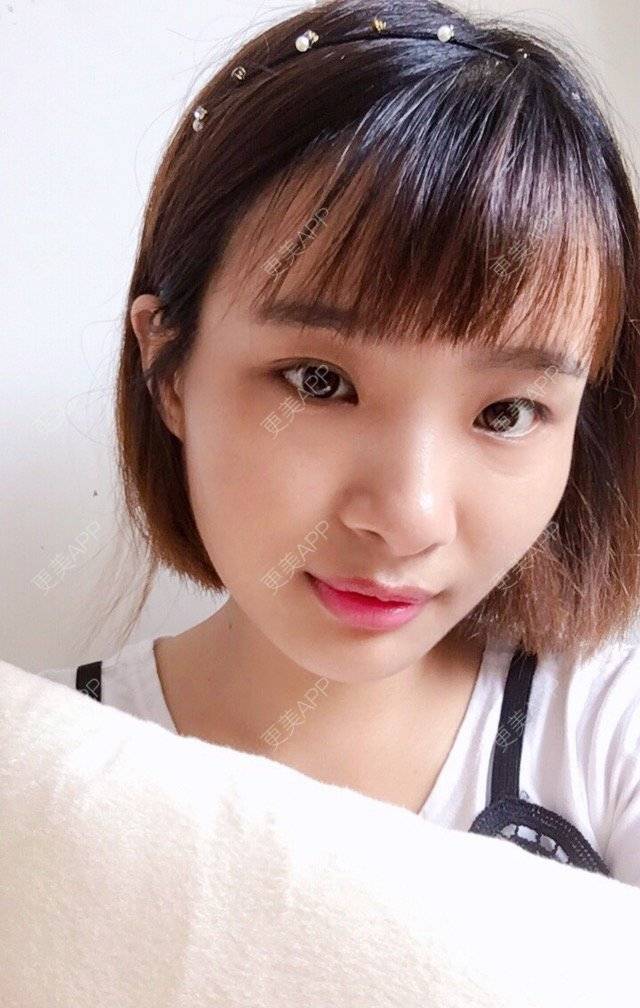 更美 - 照相机、的经验 | 注射美容 | 视频日记 | 重庆 | 自体脂肪丰全面部 | 吸脂手术