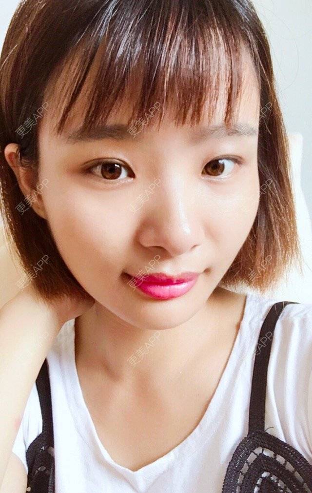 更美 - 照相机、的经验 | 注射美容 | 视频日记 | 重庆 | 自体脂肪丰全面部 | 吸脂手术
